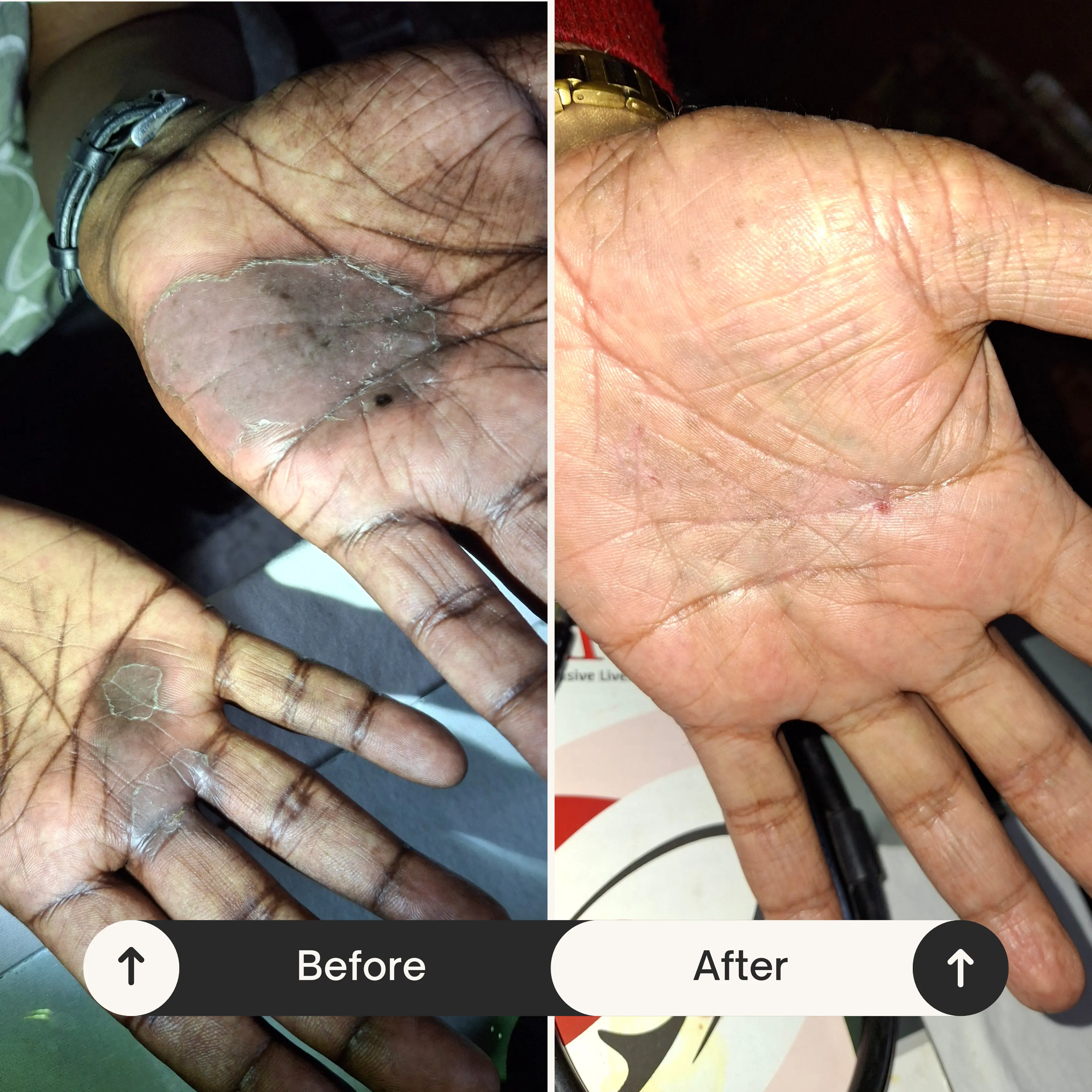 Skin Treatment Result