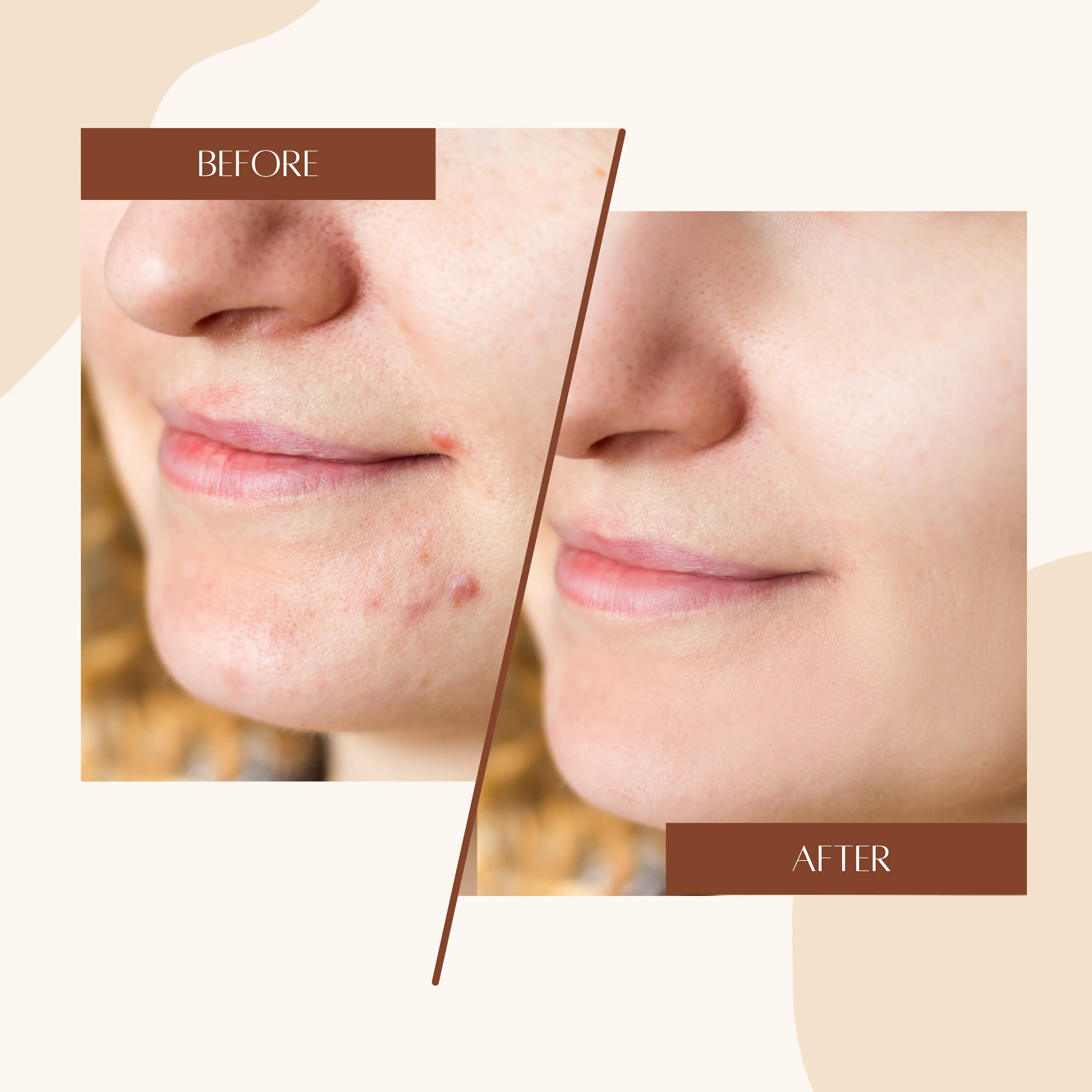 Skin Treatment Result