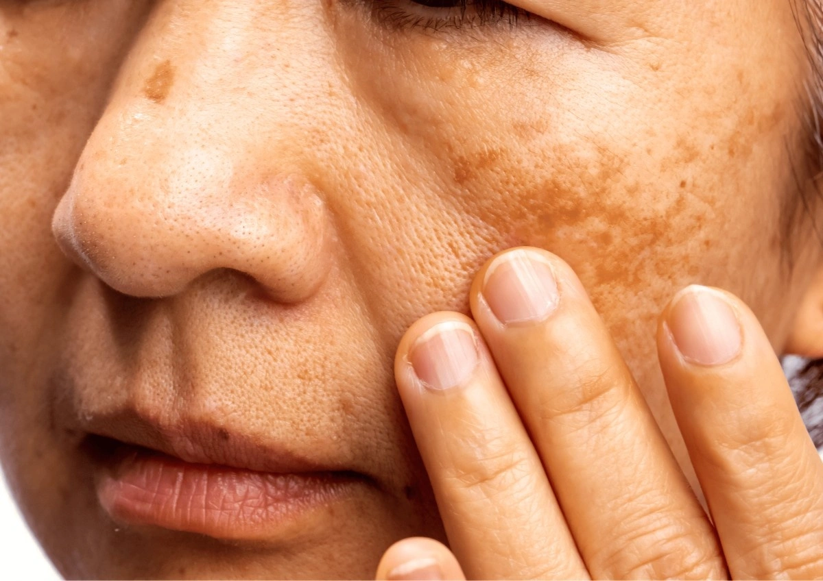 Pigmentation