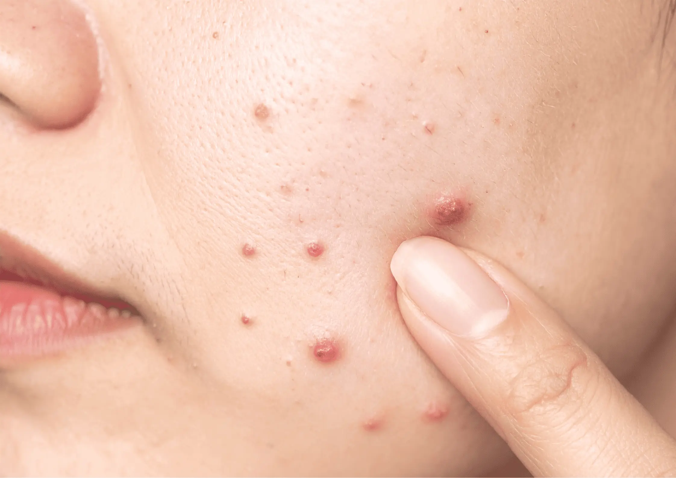 Acne & Pigmentation