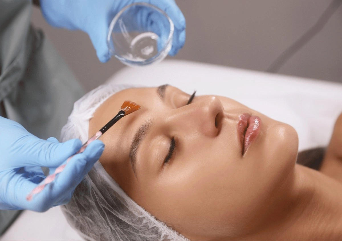 Chemical Peels