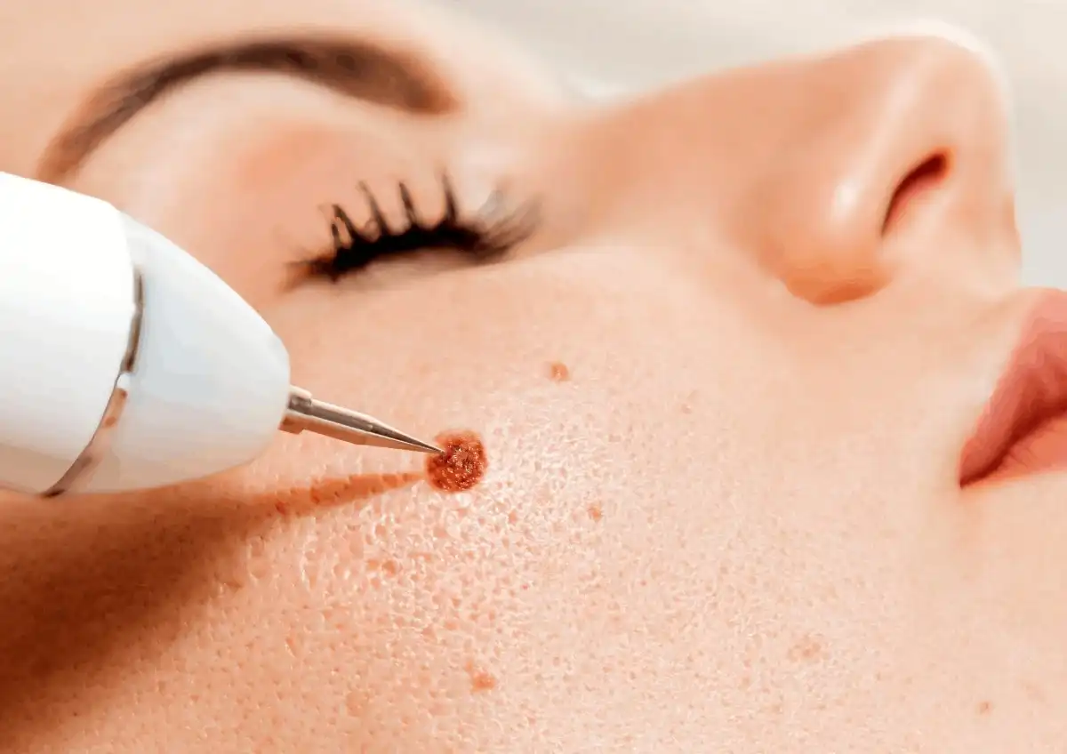 Warts & Moles Removal