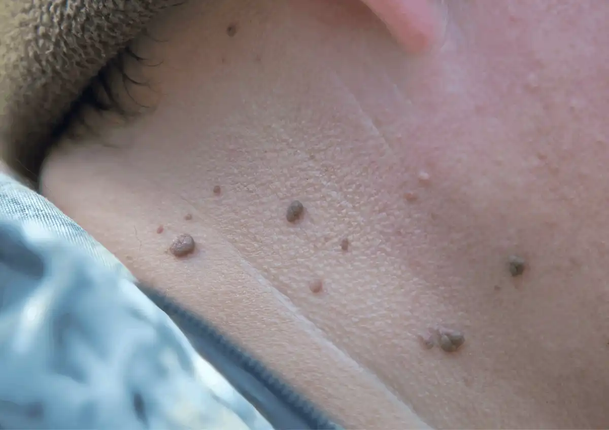 Warts & Moles