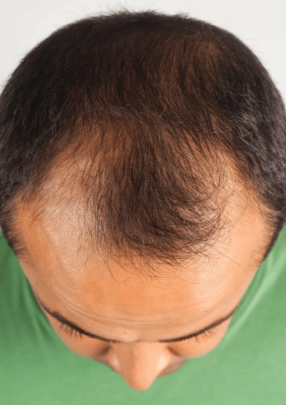 Hair Fall