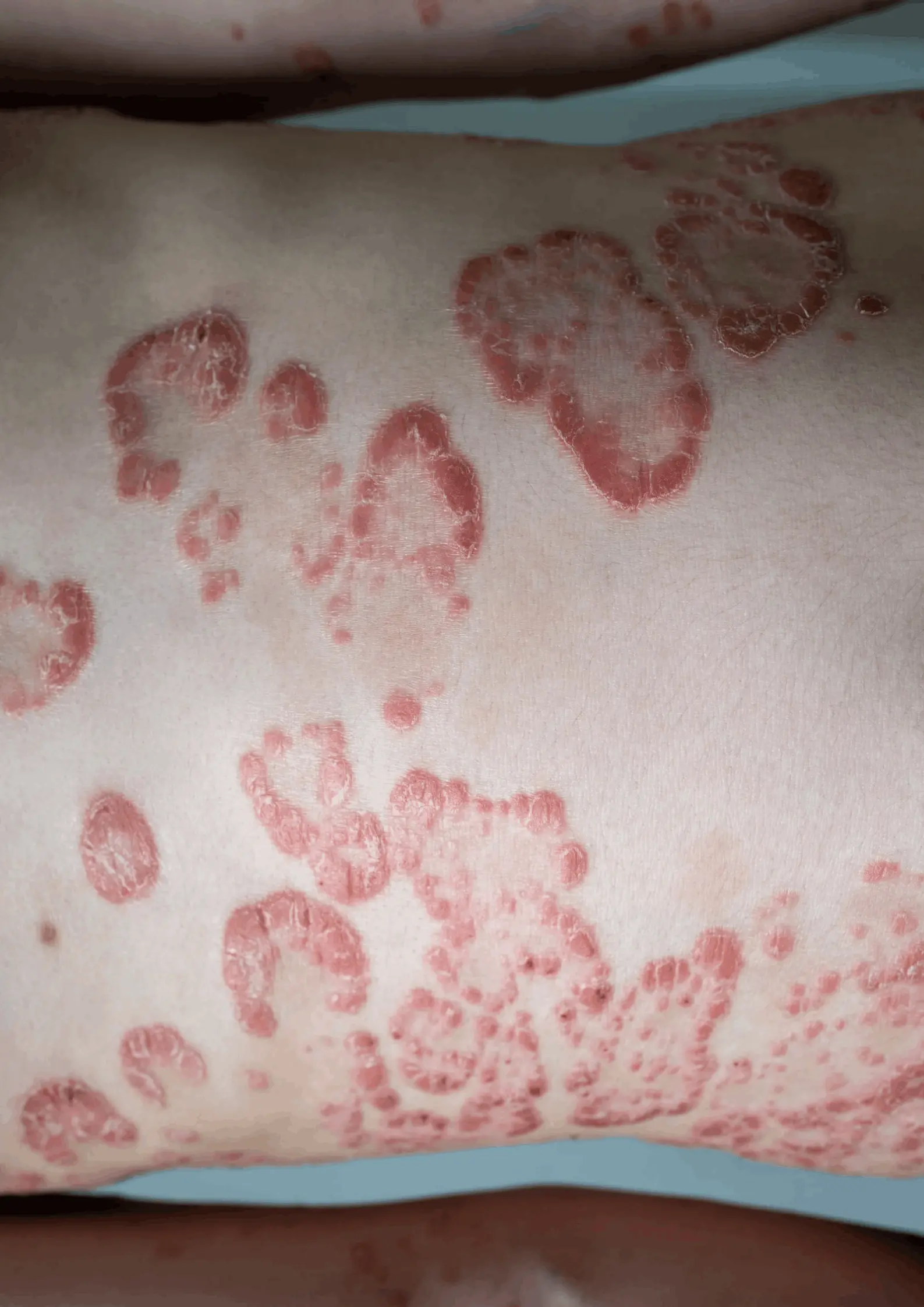 Skin Allergies
